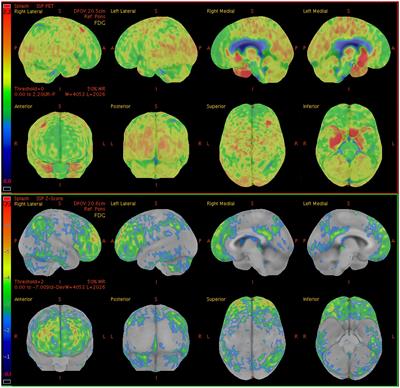 Cortical metabolic characteristics of anti-leucine-rich glioma-inactivated 1 antibody encephalitis based on 18F-FDG PET